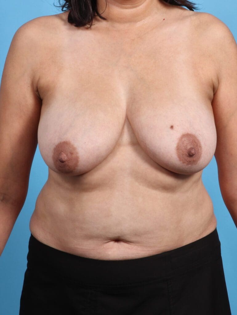 Breast Lift/Reduction w/o Implants - Case 27793 - Before