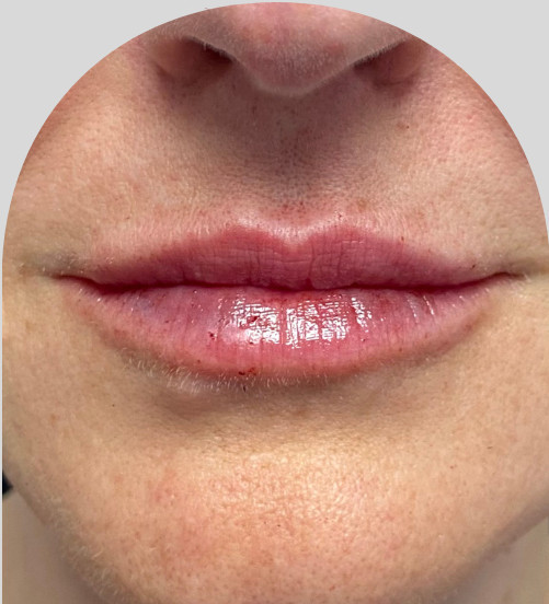 Lip Fillers - Case 28178 - After