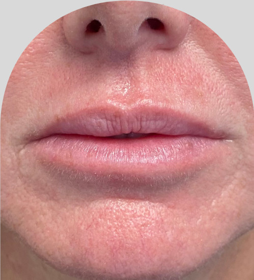 Lip Fillers - Case 28182 - Before
