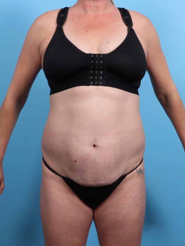 Tummy Tuck - Case 28329 - Before