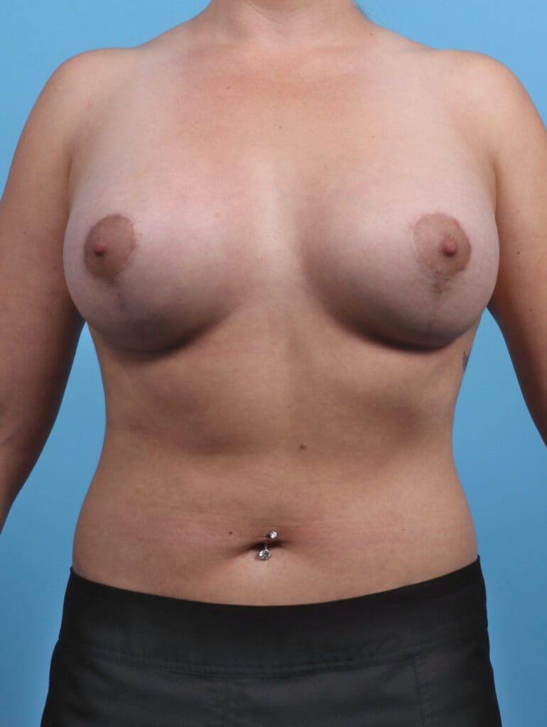 Breast Lift/Reduction with Implants - Case 28500 - After