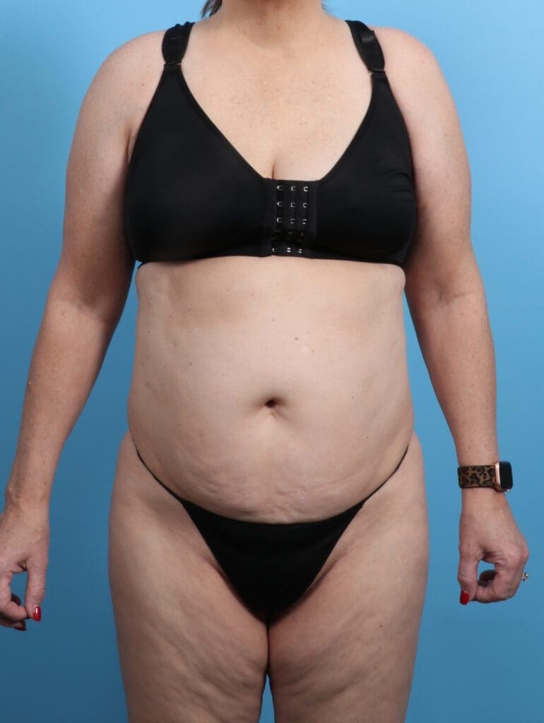 Tummy Tuck - Case 28518 - Before