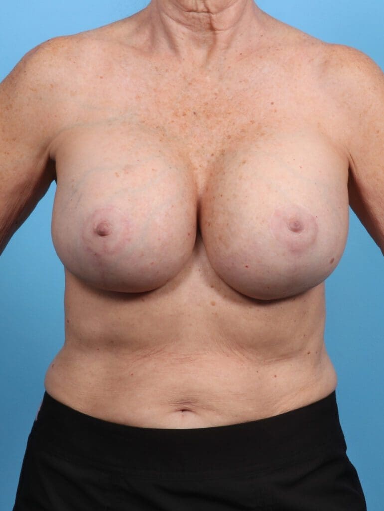 Breast Implant Revision - Case 28837 - After