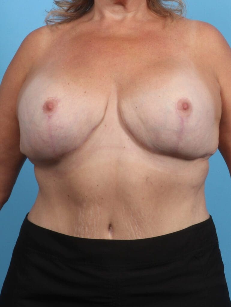 Breast Implant Revision - Case 28855 - After
