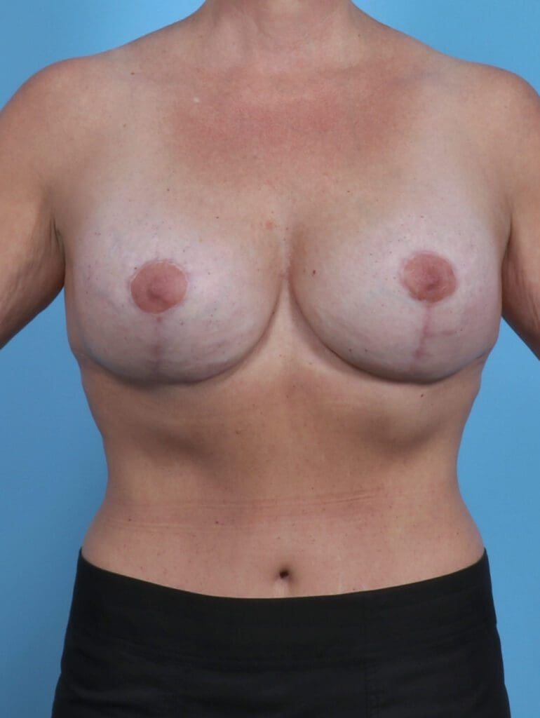 Breast Implant Revision - Case 28944 - After