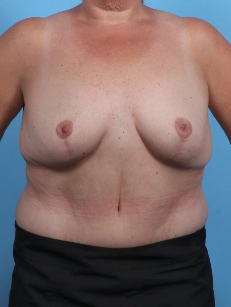 Breast Implant Revision - Case 29020 - After