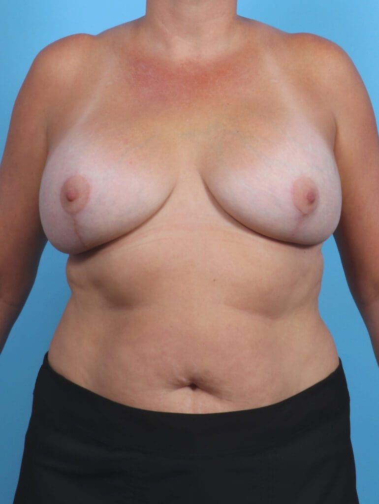 Breast Lift/Reduction with Implants - Case 29225 - After