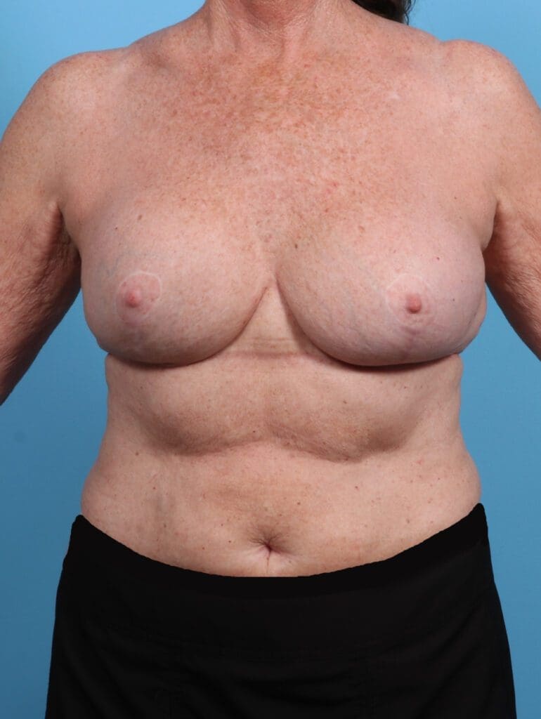 Breast Implant Revision - Case 29343 - After