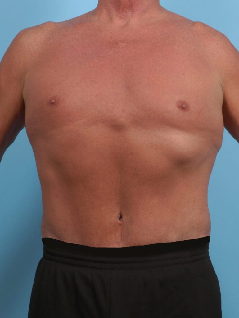 Male Tummy Tuck - Case 29361 - After