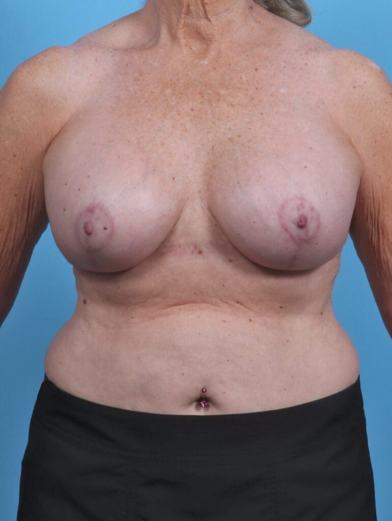 Breast Implant Revision - Case 29446 - After