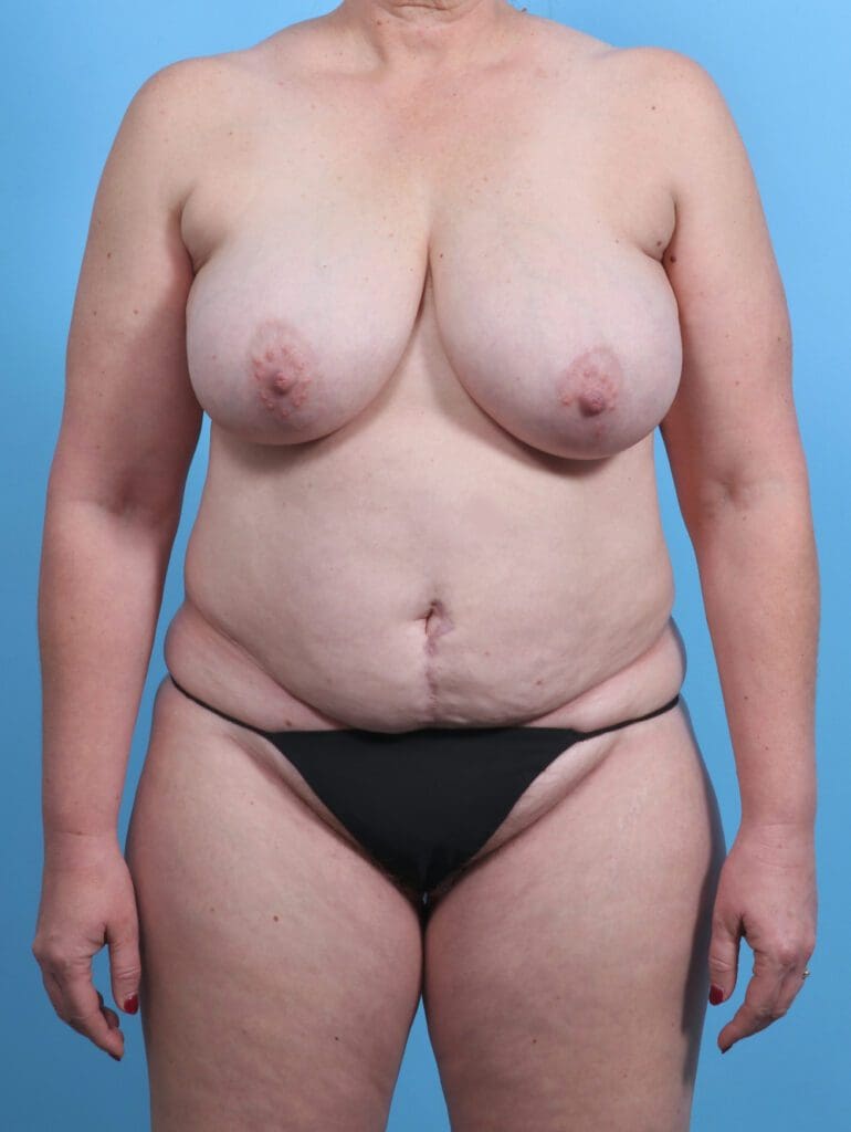 Breast Lift/Reduction w/o Implants - Case 29697 - Before