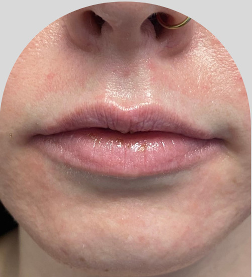 Lip Fillers - Case 29723 - Before