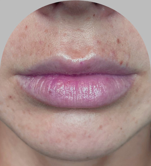 Lip Fillers - Case 29727 - Before
