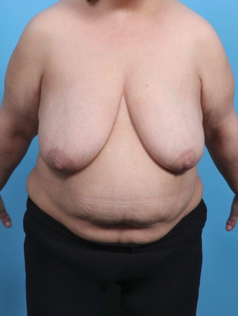 Breast Lift/Reduction w/o Implants - Case 29745 - Before