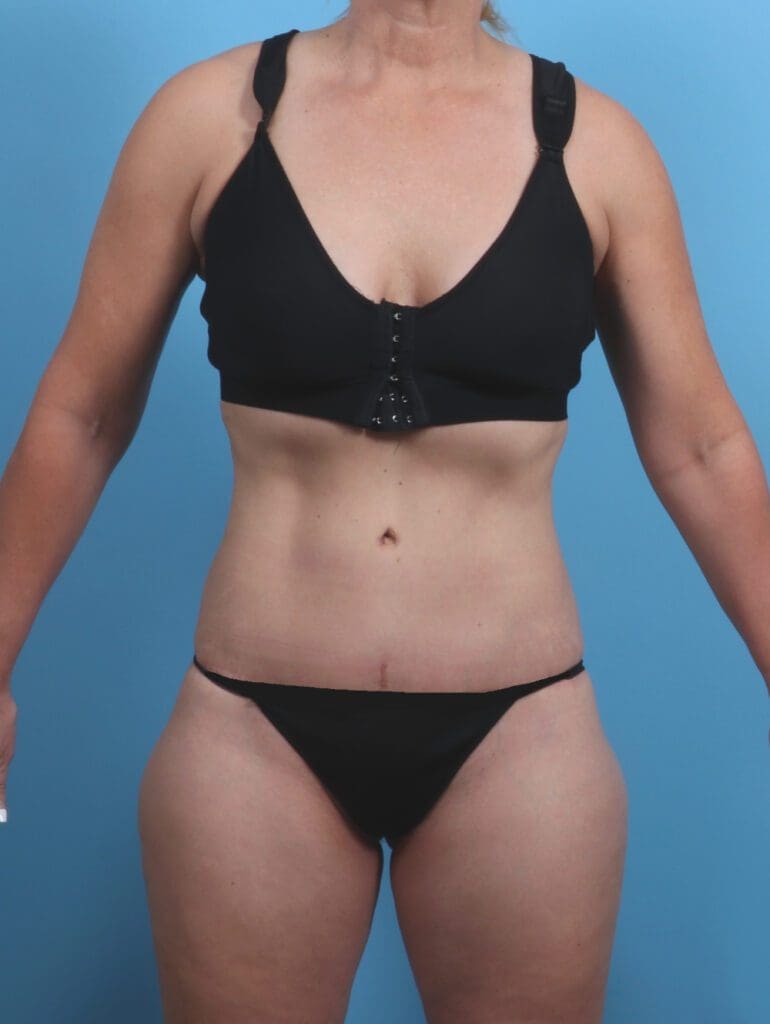 Tummy Tuck - Case 30271 - After