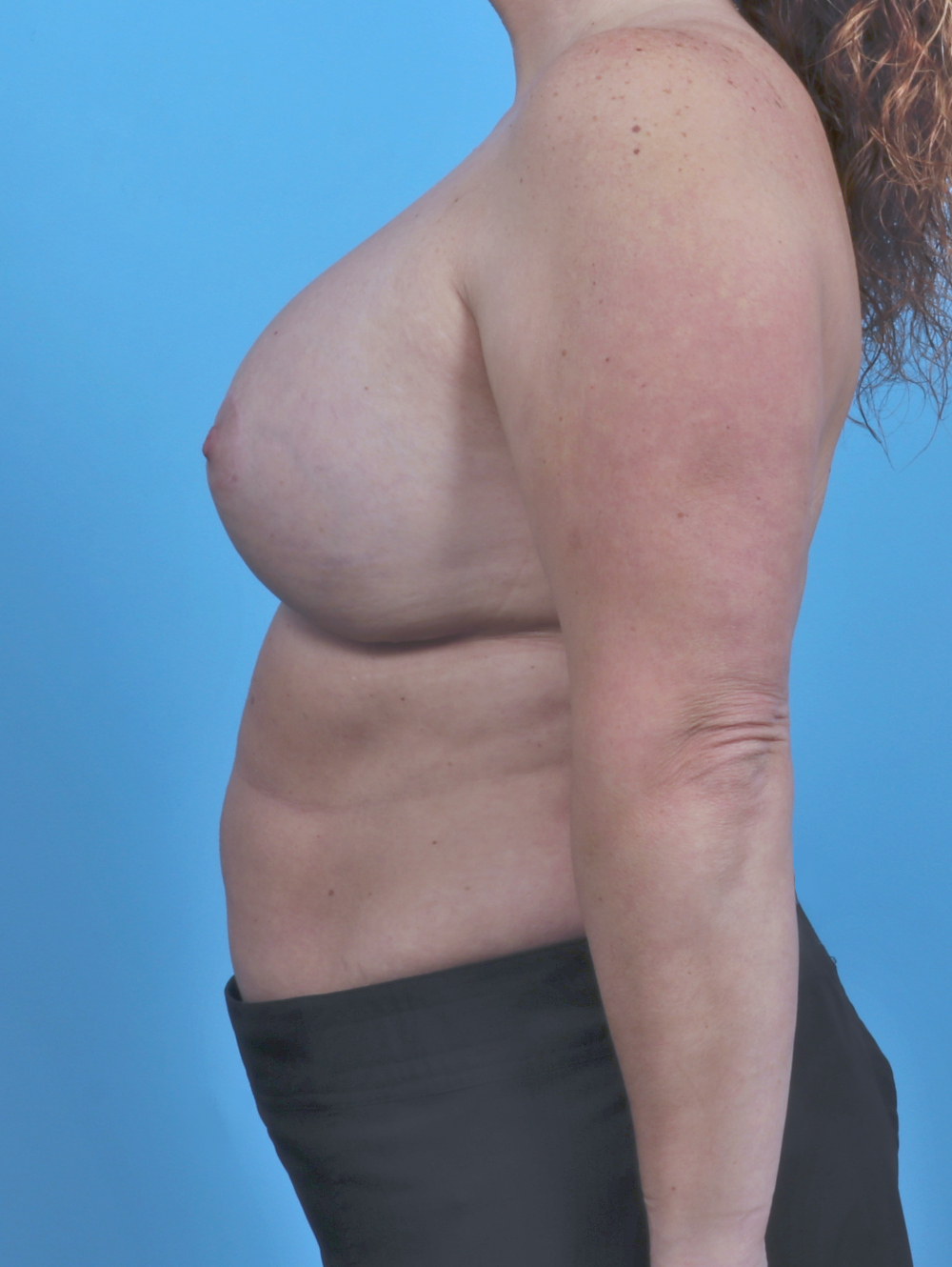 Breast Lift/Reduction with Implants Patient Photo - Case 44943 - after view-2
