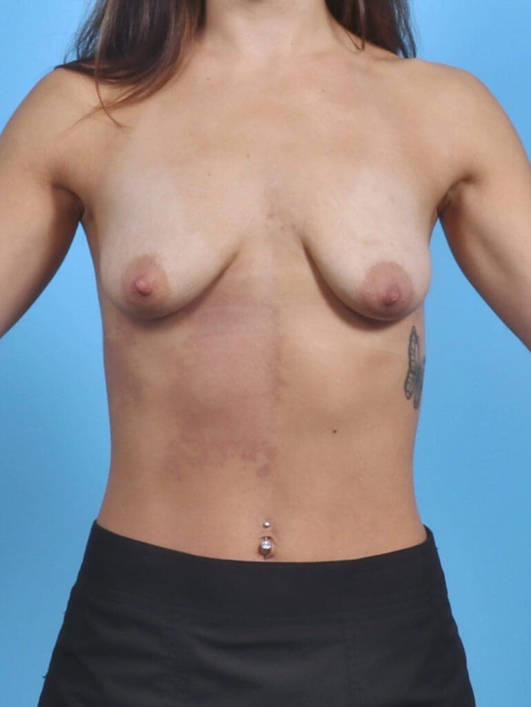 Breast Lift/Reduction with Implants - Case 45196 - Before