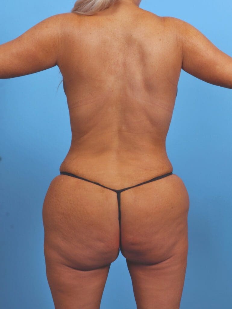 Brazilian Butt Lift - Case 45404 - After