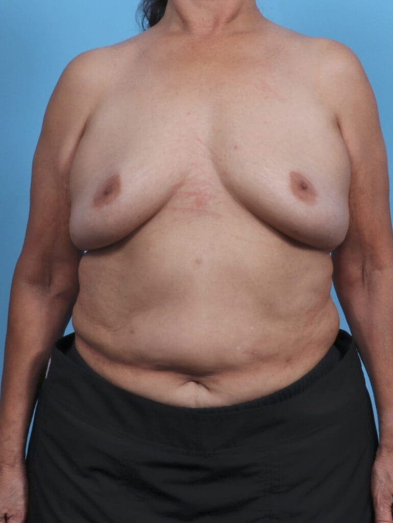 Breast Lift/Reduction w/o Implants - Case 45669 - Before