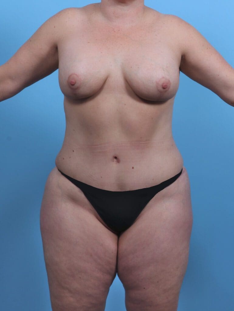 Breast Lift/Reduction with Implants - Case 45704 - After