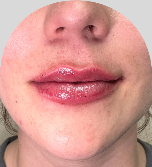 Lip Fillers - Case 45851 - After