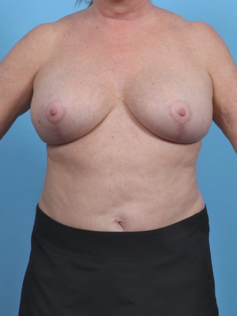 Breast Lift/Reduction with Implants - Case 46021 - After