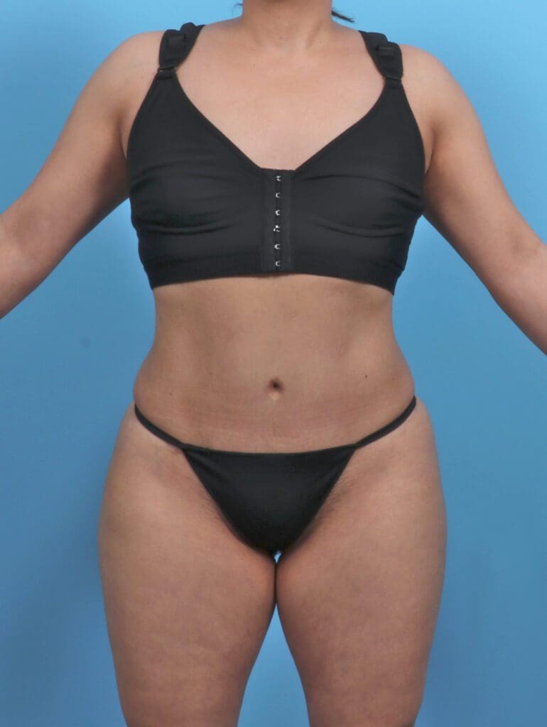 Tummy Tuck - Case 46384 - After