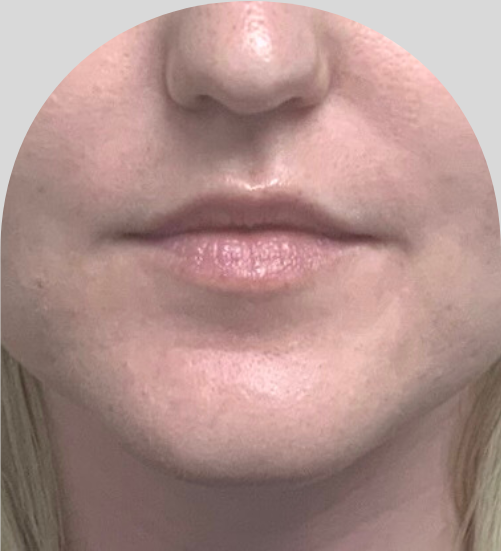 Lip Fillers - Case 46436 - Before