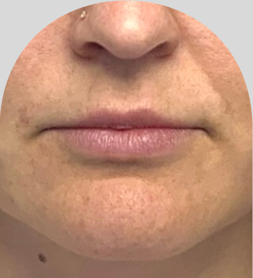 Lip Fillers - Case 46444 - Before