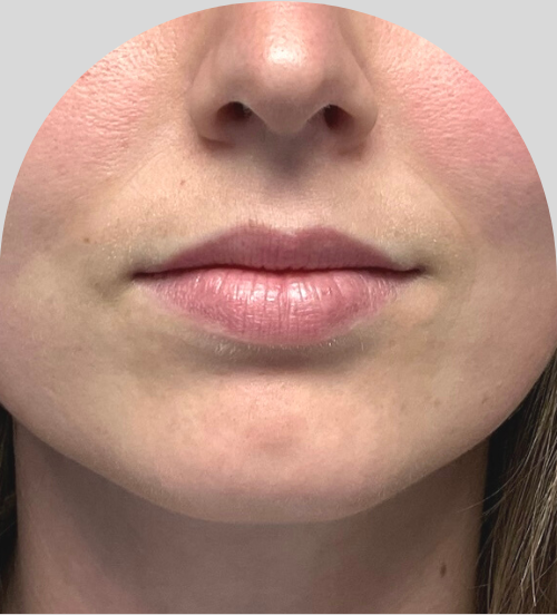 Lip Fillers - Case 46448 - Before