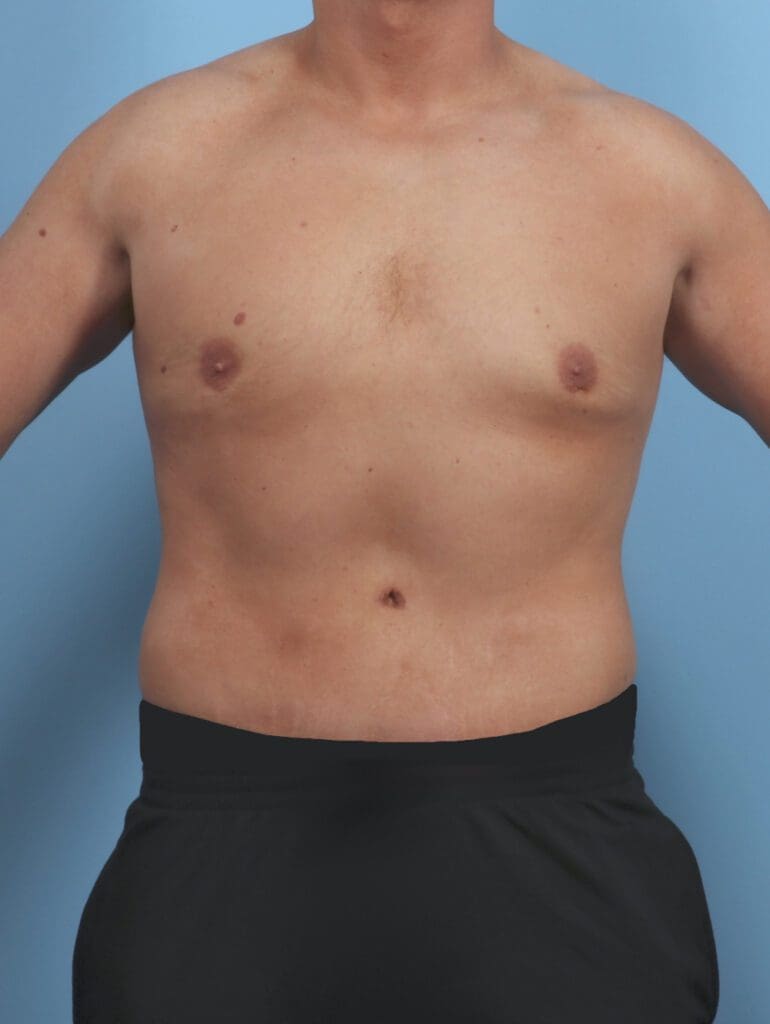 Male Body Lift - Case 46469 - After
