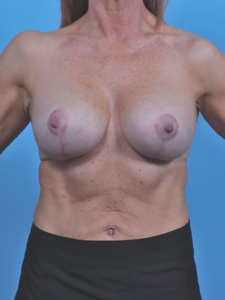 Breast Lift/Reduction with Implants - Case 46601 - After