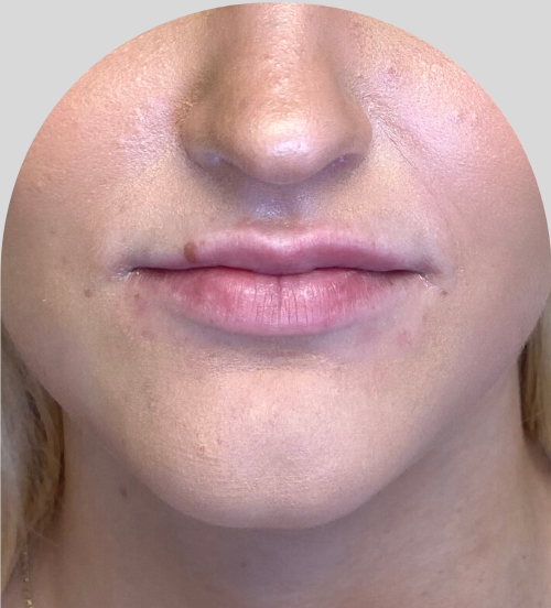 Lip Fillers - Case 46612 - Before