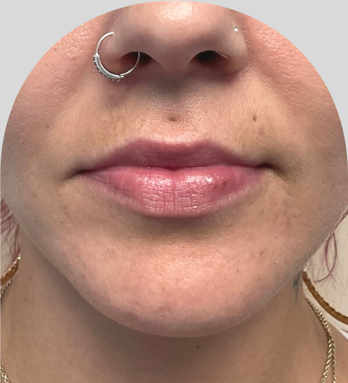 Lip Fillers - Case 46627 - Before