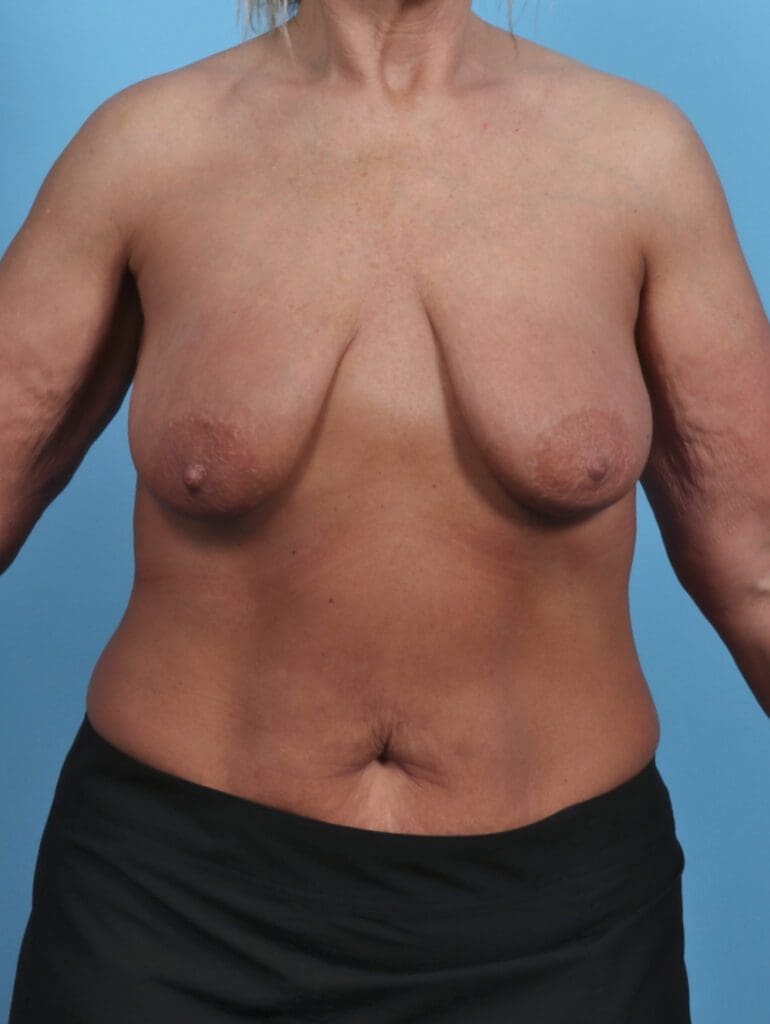 Breast Lift/Reduction with Implants - Case 46663 - Before