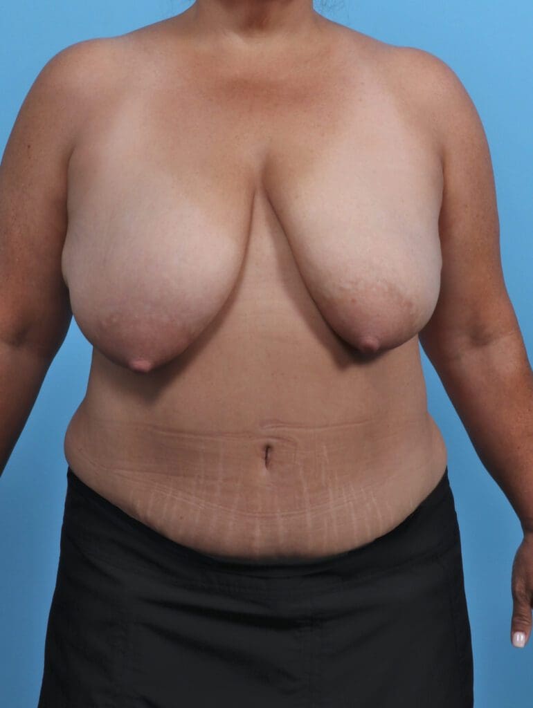 Breast Lift/Reduction w/o Implants - Case 46861 - Before