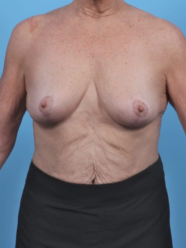 Breast Lift/Reduction w/o Implants - Case 46878 - After