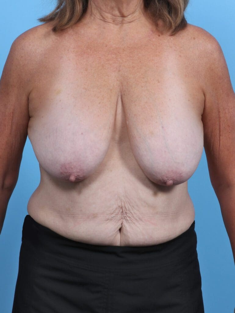 Breast Lift/Reduction w/o Implants - Case 46878 - Before