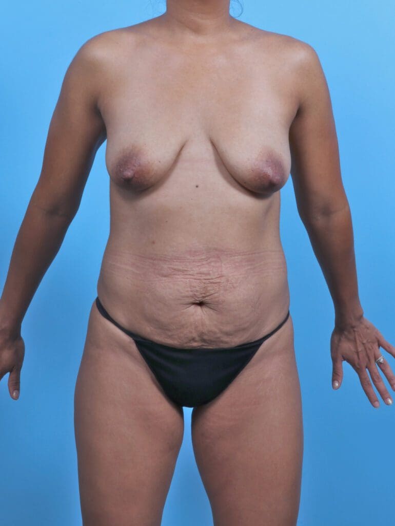 Breast Lift/Reduction with Implants - Case 46931 - Before