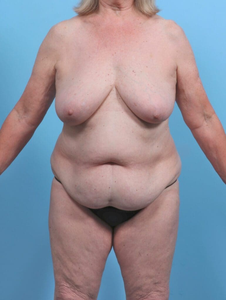 Breast Lift/Reduction with Implants - Case 46993 - Before