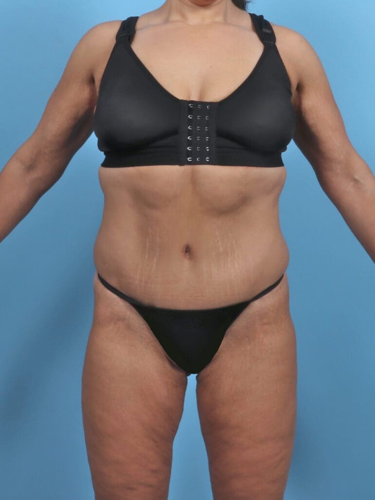 Tummy Tuck - Case 47088 - After