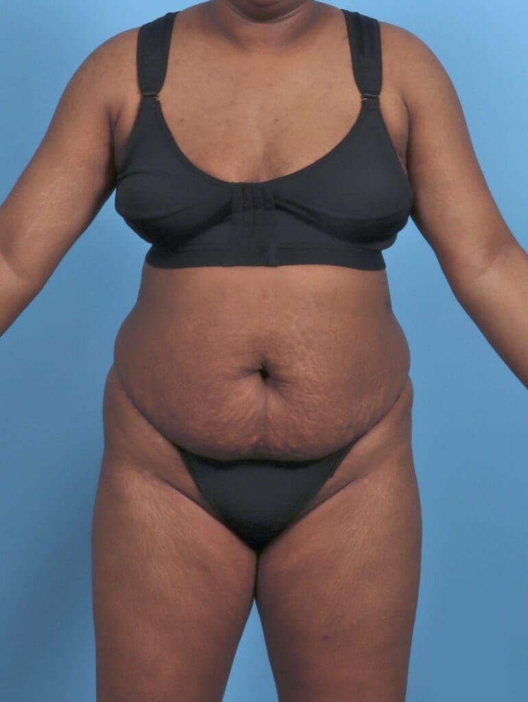 Tummy Tuck - Case 47128 - Before