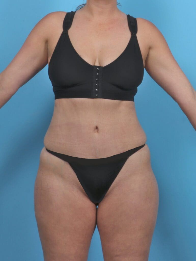 Tummy Tuck - Case 47233 - After
