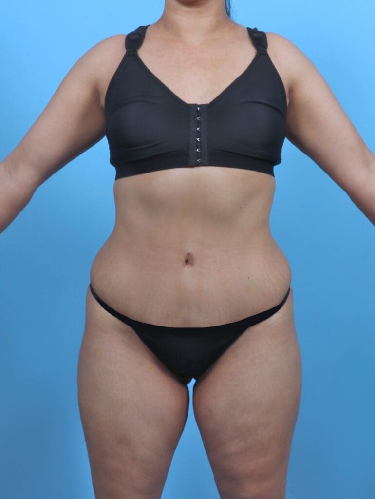 Tummy Tuck - Case 47388 - After