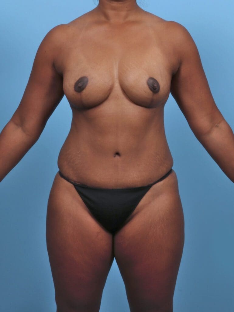 Tummy Tuck - Case 47412 - After