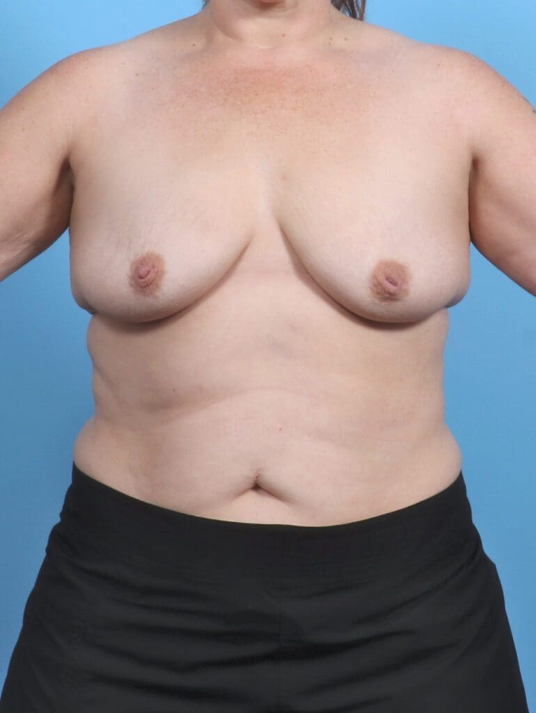 Breast Lift/Reduction with Implants - Case 47995 - Before