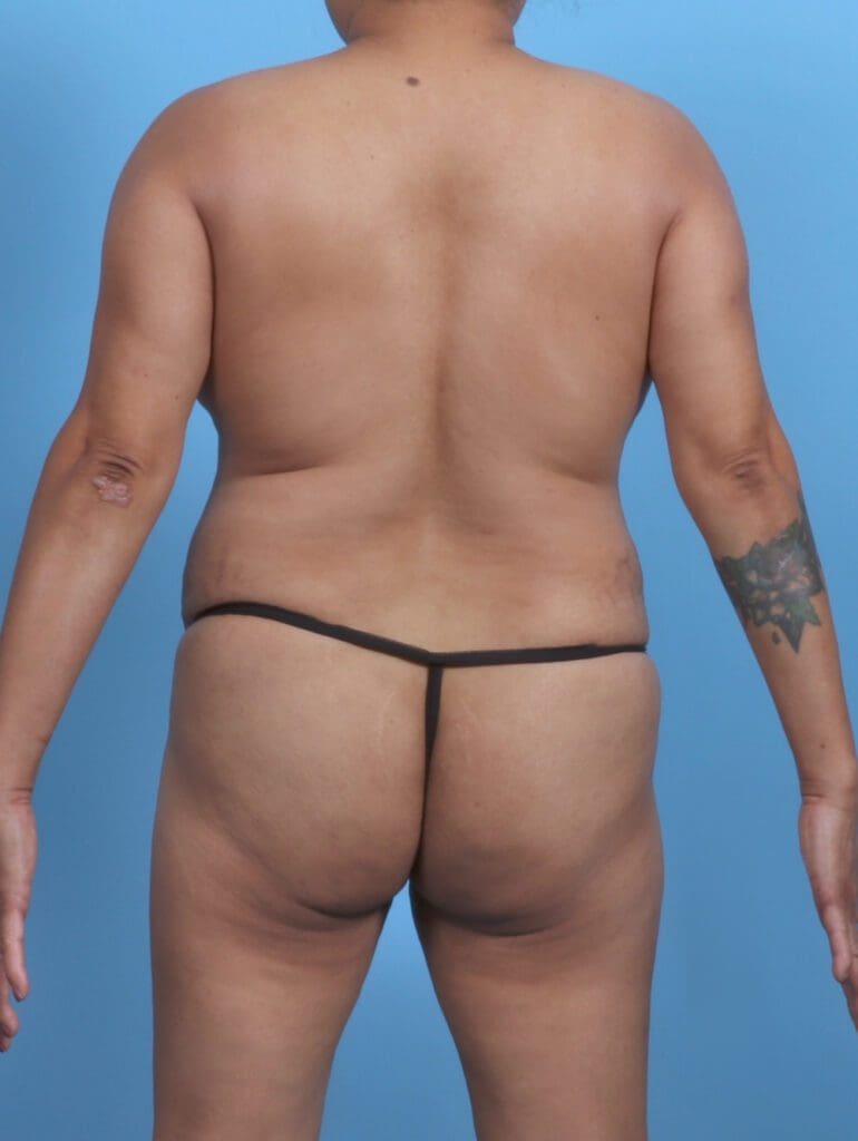 Liposuction - Case 48152 - Before