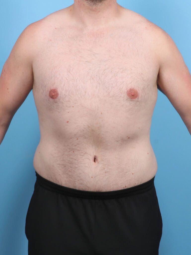 Male Tummy Tuck - Case 48162 - After