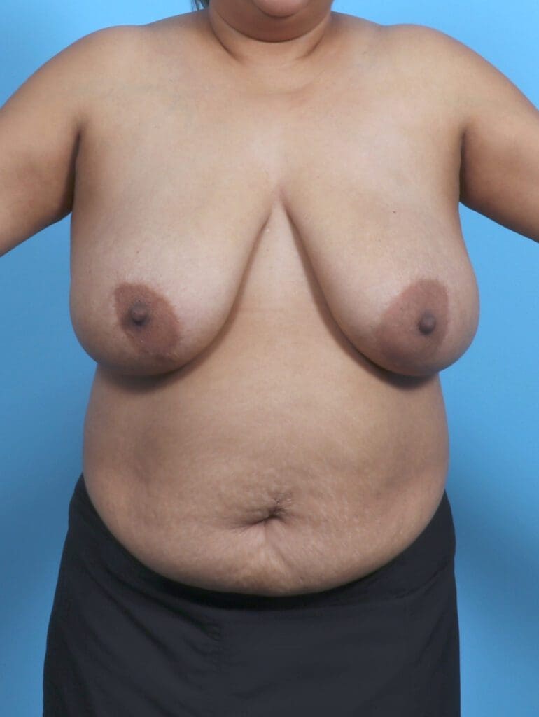 Breast Lift/Reduction w/o Implants - Case 48231 - Before