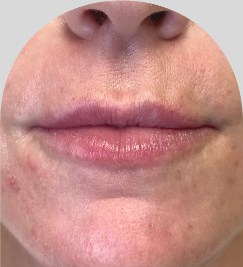 Lip Fillers - Case 48317 - Before